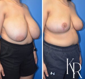 Before and after breast reduction