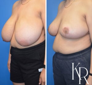 Before and after breast reduction