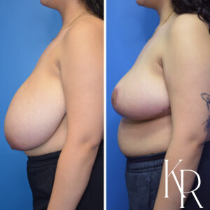 Before and after breast reduction