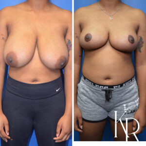 Before and after breast reduction