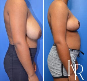 Before and after breast reduction