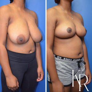 Before and after breast reduction