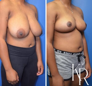 Before and after breast reduction