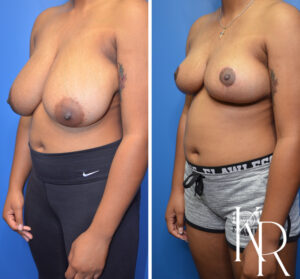 Before and after breast reduction