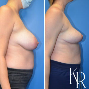 Before and after breast reduction