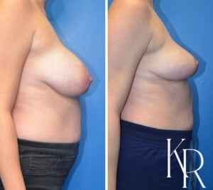 Before and after breast reduction