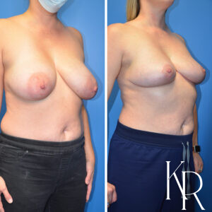 Before and after breast reduction