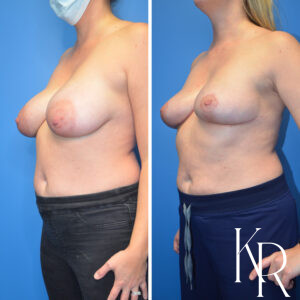 Before and after breast reduction