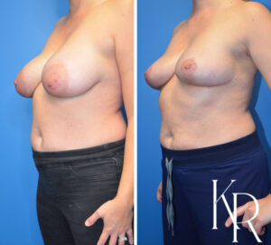 Before and after breast reduction
