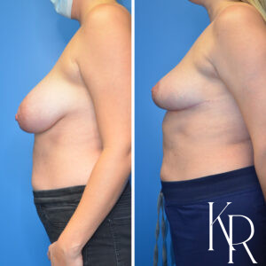 Before and after breast reduction