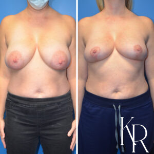 Before and after breast reduction