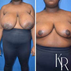 Before and after breast reduction