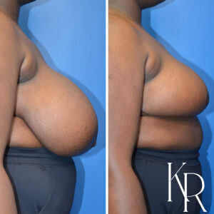 Before and after breast reduction