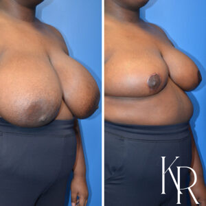 Before and after breast reduction
