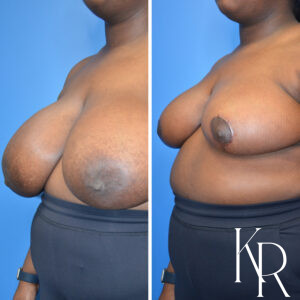 Before and after breast reduction