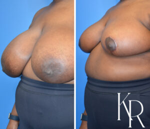 Before and after breast reduction