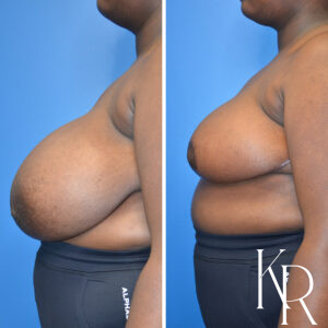 Before and after breast reduction