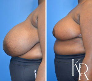 Before and after breast reduction