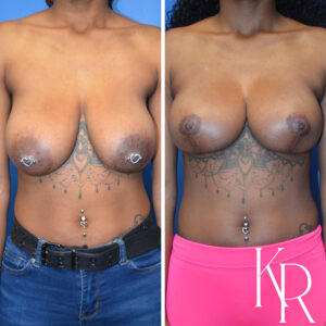 Before and after breast reduction