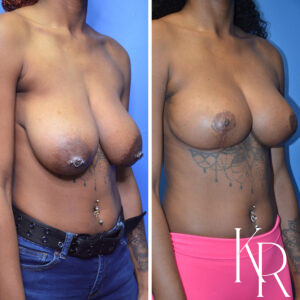 Before and after breast reduction