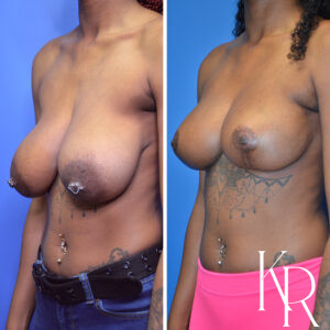 Before and after breast reduction