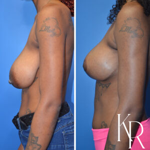 Before and after breast reduction