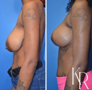 Before and after breast reduction