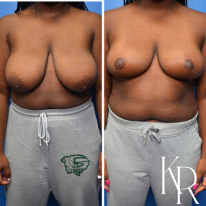 Before and after breast reduction