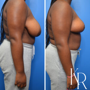 Before and after breast reduction