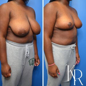 Before and after breast reduction