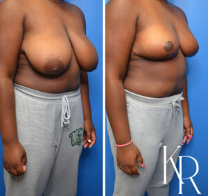 Before and after breast reduction