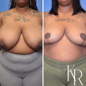 Before and after breast reduction