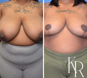 Before and after breast reduction