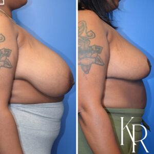 Before and after breast reduction