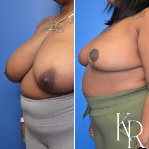 Before and after breast reduction