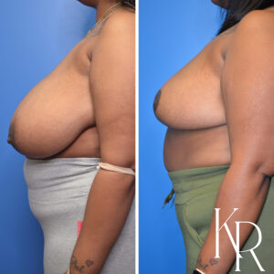 Before and after breast reduction