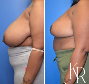 Before and after breast reduction