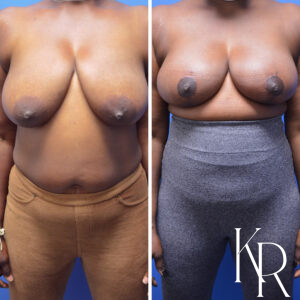 Before and after breast reduction