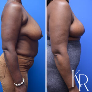 Before and after breast reduction