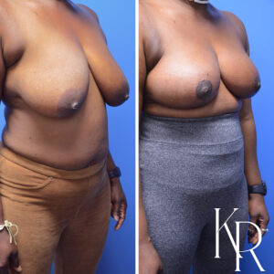 Before and after breast reduction