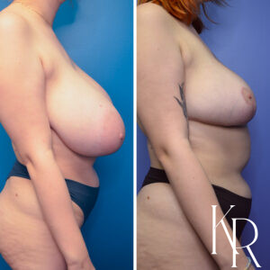 Before and after breast reduction