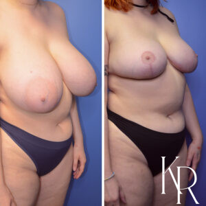 Before and after breast reduction