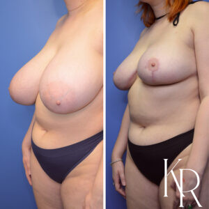 Before and after breast reduction