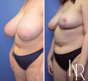 Before and after breast reduction
