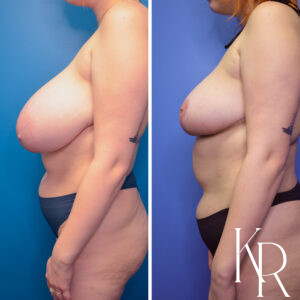 Before and after breast reduction