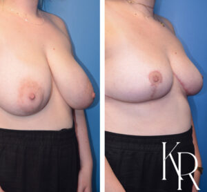 Before and after breast reduction