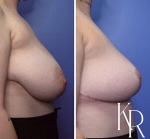 Before and after breast reduction