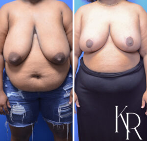 Before and after breast reduction