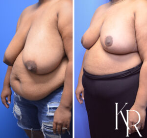 Before and after breast reduction
