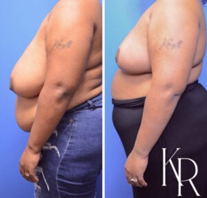 Before and after breast reduction